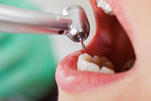 Best Emergency Wisdom Tooth Extraction in Oak Park, CA